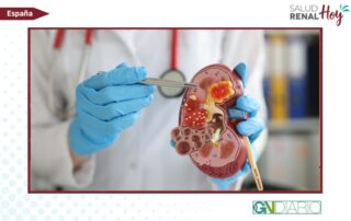 GN Diario: Ensayo clínico multicéntrico sobre la prevención de la lesión renal postoperatoria mediante IA
