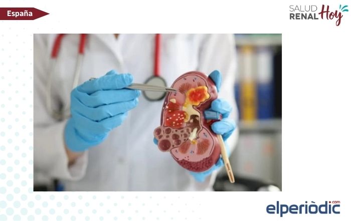 elperiòdic.com: 770.000 personas enfermedad renal en Valencia