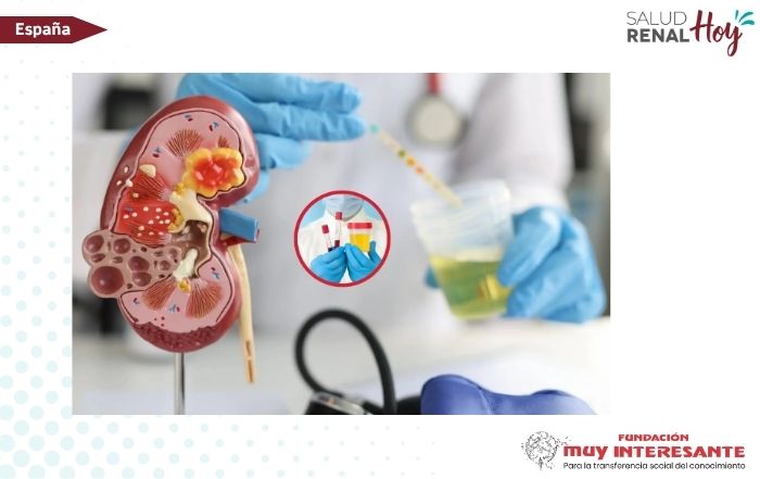 Muy Interesante: ¿Sabías que puedes tener una enfermedad renal sin darte cuenta?