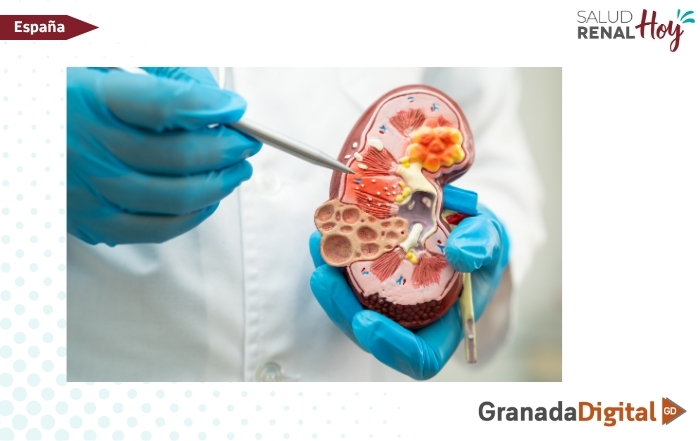 Granada digital: 'Salud con H-alma' tratará este miércoles la enfermedad renal crónica