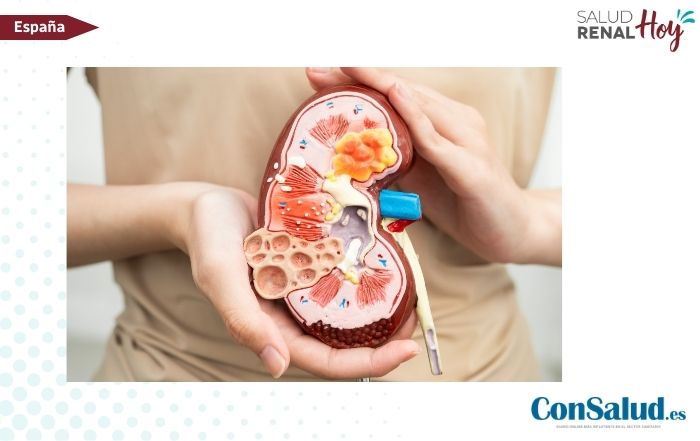 ConSalud.es: Transformación del abordaje de la Nefropatía por IgA