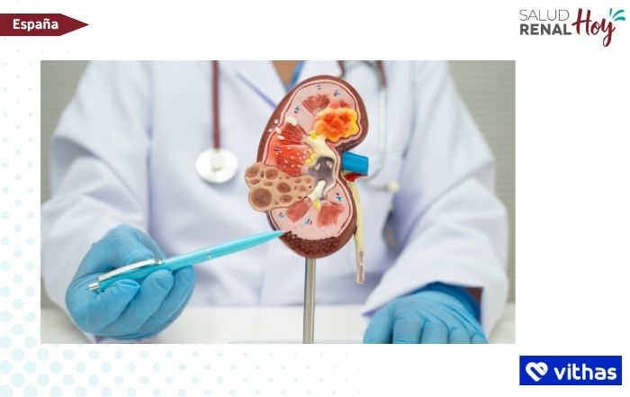Vithas: Un tercio de los casos de enfermedad renal crónica son atribuibles a afecciones como la diabetes