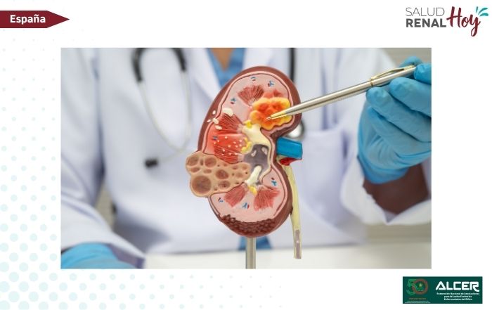 ALCER: Las CAR-T saltan de la oncología a los trasplantes