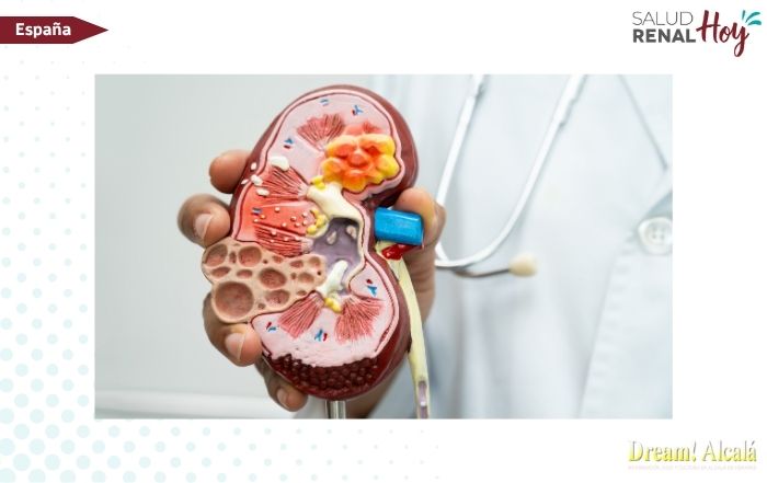 Dream! Alcalá: Un proyecto para detectar a tiempo la enfermedad renal crónica