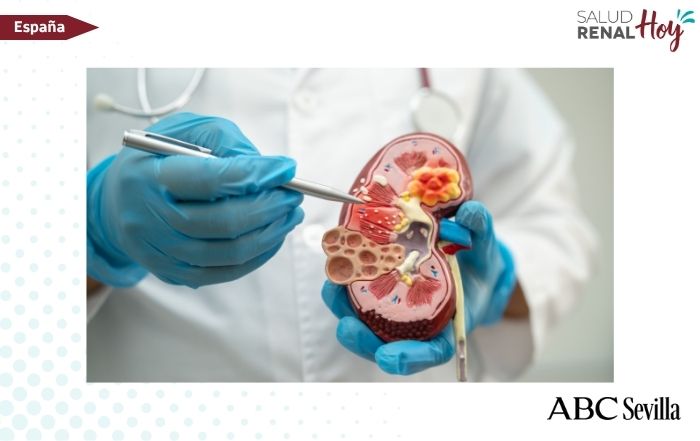 ABC Sevilla: Extirpan un tumor renal raro de 17 centímetros en un hospital de Sevilla