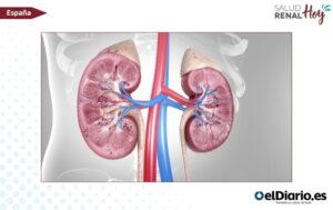 elDiario.es: Primer trasplante renal entre personas con VIH elDiario.es: Primer trasplante renal entre personas con VIH